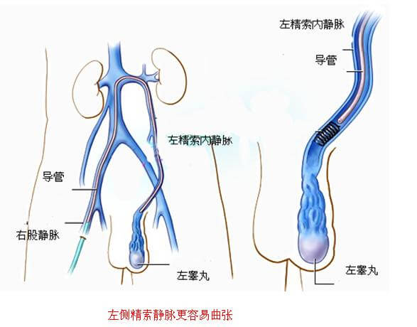 精索靜脈曲張手術(shù)費用